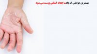 پیشگیری و درمان خشکی پوست