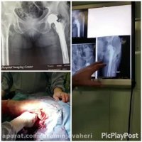 عفونت مفصل مصنوعي لگن و كارگذاري اسپيسر سيماني حاوي انتي بيوتيك