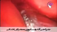 فیلم واقعی جراحی آندوسکوپی مجرای اشکی