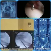 علاج سواد المشاشه