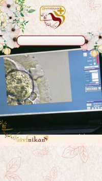 بیوپسی از جنین