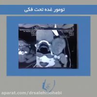 جراحی تومور غده تحت فکی