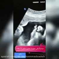 سونوگرافی صورت جنین