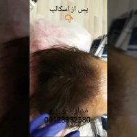 اسکالپ پس از کاشت مو