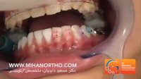 ارتودنسی همرنگ دندان | دکتر مسعود داودیان