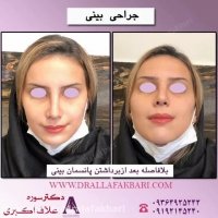 نتیجه جراحی بینی توسط دکتر سوره علاف اکبری