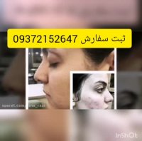 کرم گیاهی لازان چه خصوصیاتی دارد ؟؟(درمان چین و چروکلک های پوستی و..)