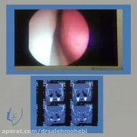 گرفتگی شدید یکطرفه بینی