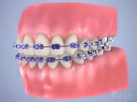 ارتودنسی و انواع آن