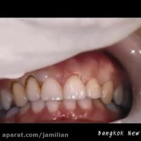 افزایش طول تاج کلینیکی