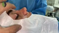 جراحی بینی به فرم پرانتزی با پوست ضخیم | دکتر باستانی نژاد