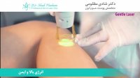 لیزر موهای زائد با الکساندرایت کندلا 2019