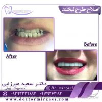 اصللاح طرح لبخند