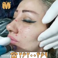 فیلم میکرونیدلینگ