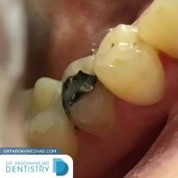 تعویض و ترمیم دندان های ترمیمی