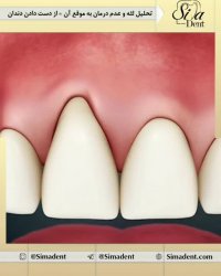 تحلیل لثه | دندانپزشکی سیمادنت