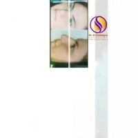 بلافاصله بعد از عمل بینی