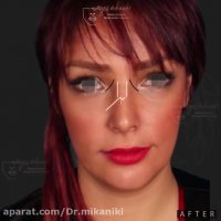 فیلم جراحی بینی طبیعی