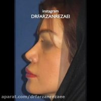 جراحی همزمان لیفت صورت با جراحی بینی و تزریق چربی