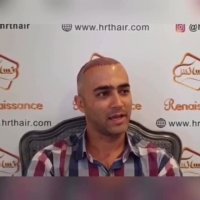 کاشت مو به روش انحصاری sutدر کلینیک تخصصی رنسانس