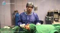 فیلم جراحی بینی با انحراف شدید
