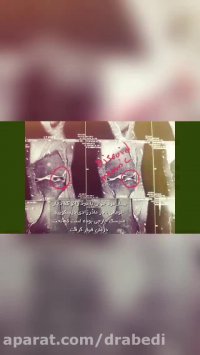 درمان درد زانو