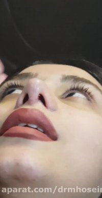 برداشتن گچ بینی گوشتی