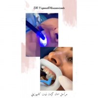 لامینت کامپوزیتی دندان