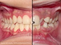 قبل و بعد از ارتودنسی دندان | دکتر محمودهاشمی