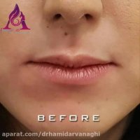 فیلم واقعی تزریق فیلر لب