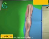 فیلم جراحی انحراف زانو در کودکان (زانوی پرانتزی و ضربدری)