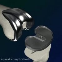 تعویض مفصل زانو