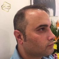 کاشت مو به روشSUT -کلینیک تخصصی رنسانس