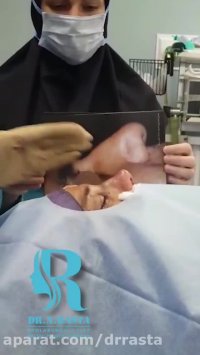 عمل واقعی بینی گوشتی با انحراف به راست