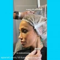 فیلم زاویه سازی فک و صورت