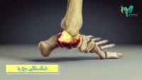 فیلم کوتاه از چگونگی شکستگی مچ پا