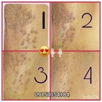 زگیل تناسلی درمان دارد