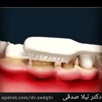 جرم گیری دندان