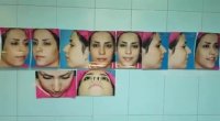 عمل بینی استخوانی توسط دکتر امید ابراهیمی بهترین جراح بینی استخوانی