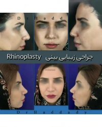 جراحی زیبایی بینی