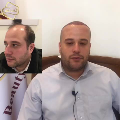 کاشت مو به روشSUT -کلینیک تخصصی رنسانس