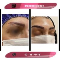 فیلم واقعی قبل و بعد کاشت ابرو با طراحی طبیعی