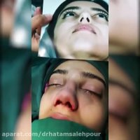 فیلم جراحی بینی توسط دکتر حاتم صالح پور
