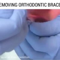 درآوردن براکت های ارتودنسی