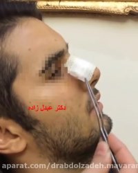جراحی زیبایی بینی