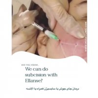 درمان جای جوش همراه با سابسیژن و ژل