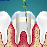عصب کشی دندان چگونه انجام میگیرد؟