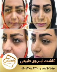کاشت ابرو با رویش طبیعی