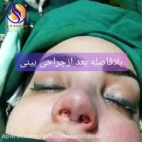 عمل جراحی بینی