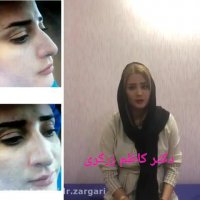فیلم جراحی بینی - دکتر زرگری